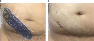 Prospective evaluation of a closed-incision negative pressure wound therapy system in kidney transplantation and its association with wound complications